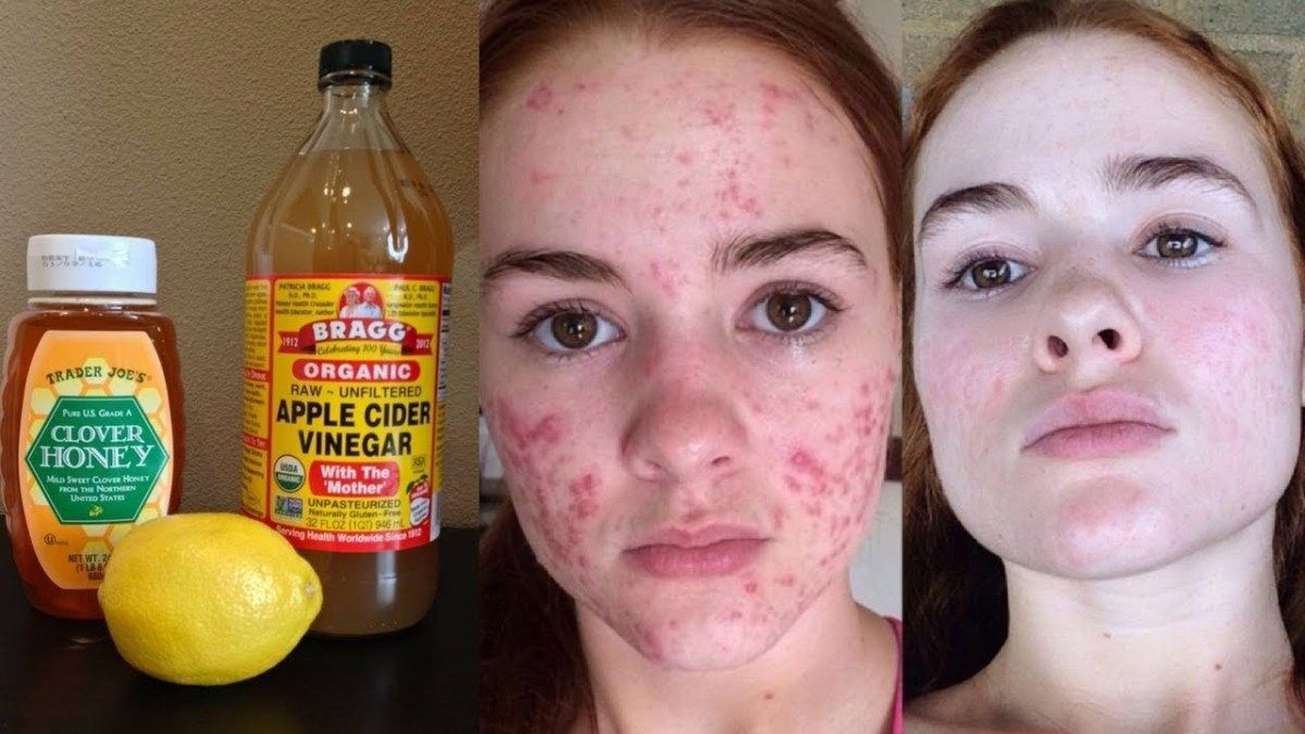 acne and warts acv
