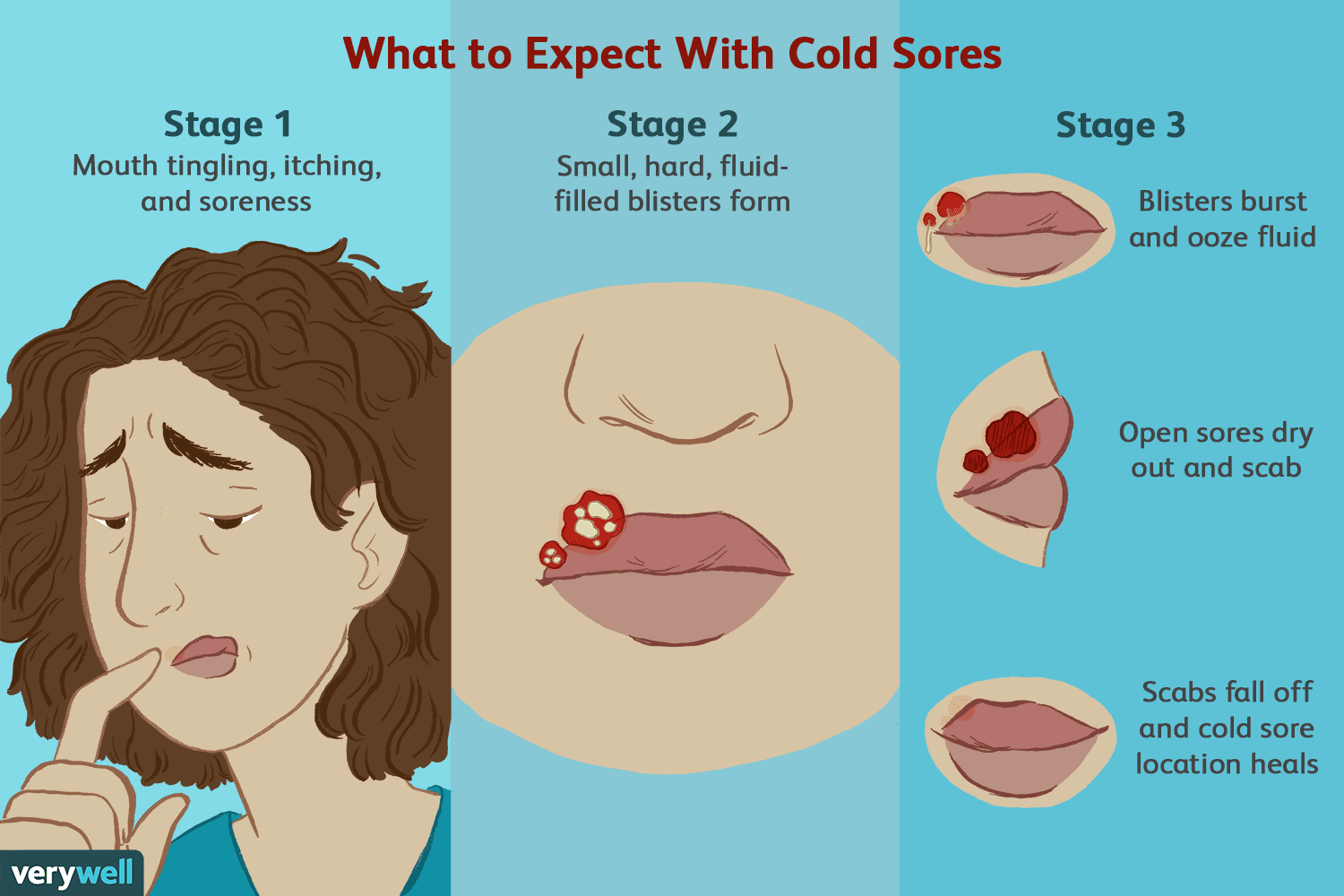 Does apple cider vinegar help with cold sores.